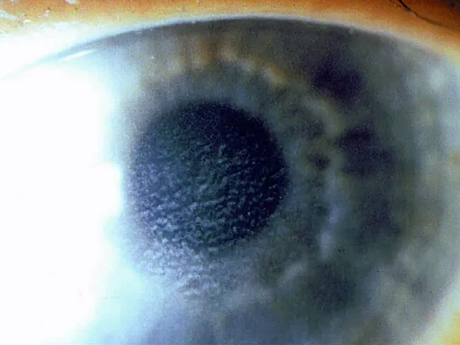 Diffuse Lamellar Keratitis : 弥漫性板层角膜炎