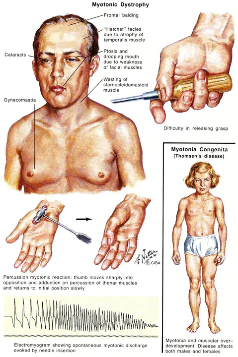 Dystrophia Myotonica Kinase : 强直性营养不良激酶