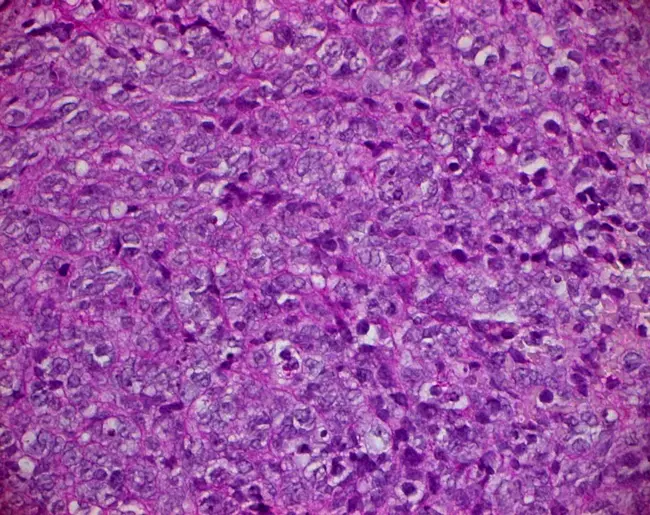 Malignant fibrous histiocytomas : 恶性纤维组织细胞瘤