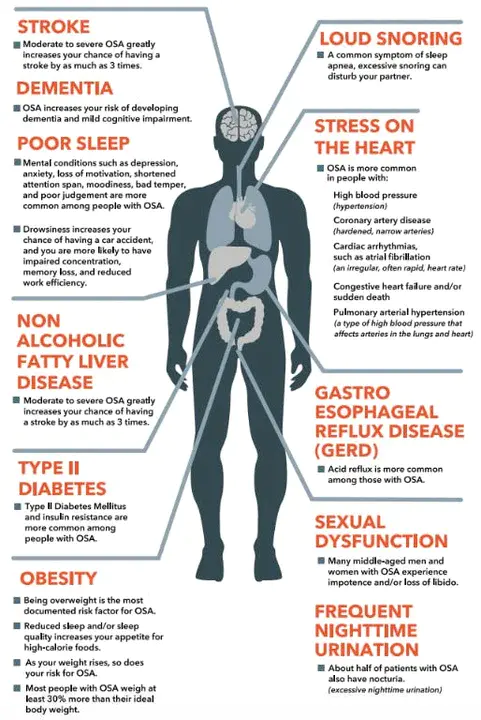 Dental Organization for Sleep Apnea : 睡眠呼吸暂停的牙科组织