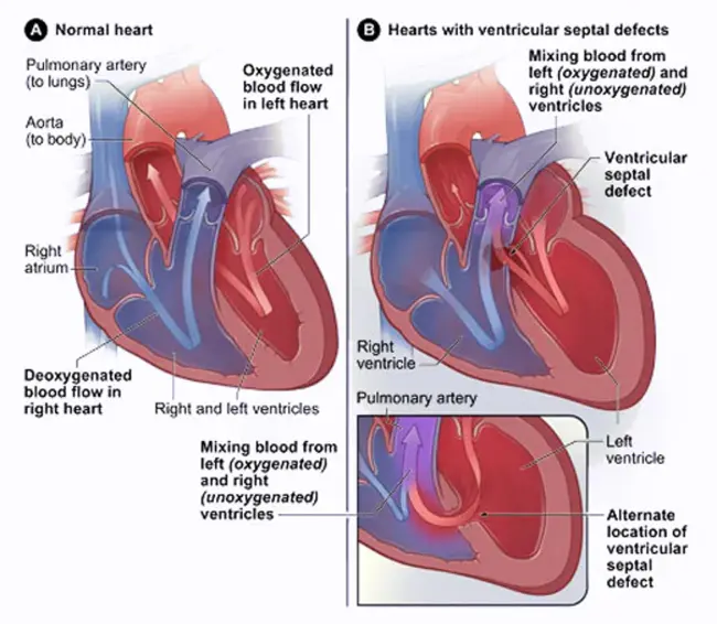 Congenital Hereditary Endothelial Dystrophy : 先天性遗传性内皮营养不良