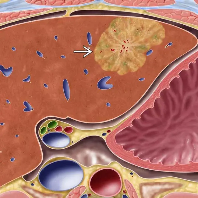 Focal Nodular Hyperplasia : 局灶性结节性增生