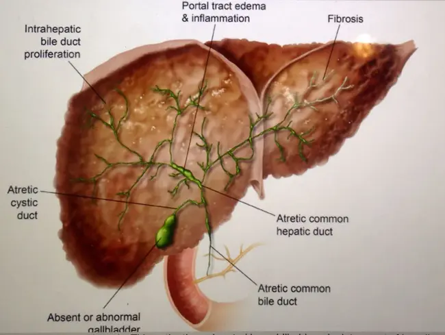 Liver Kidney Spleen : 肝肾脾