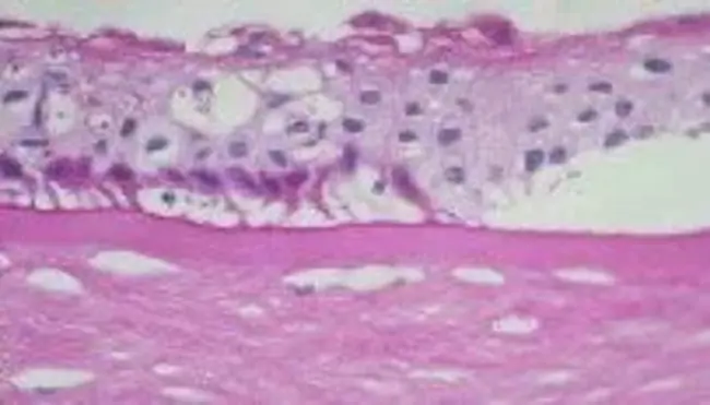 Pseudophakic Bullous Keratopathy : 假性大疱性角膜病变