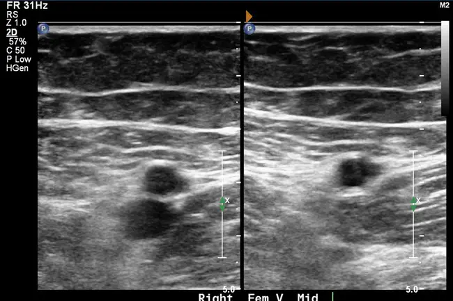 Venous Duplex Ultrasound Scanning : 静脉双超声扫描