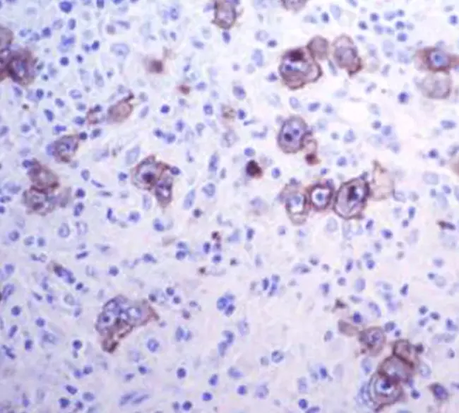 lymphocyte predominent Hodgkin lymphoma : 淋巴细胞为主的霍奇金淋巴瘤