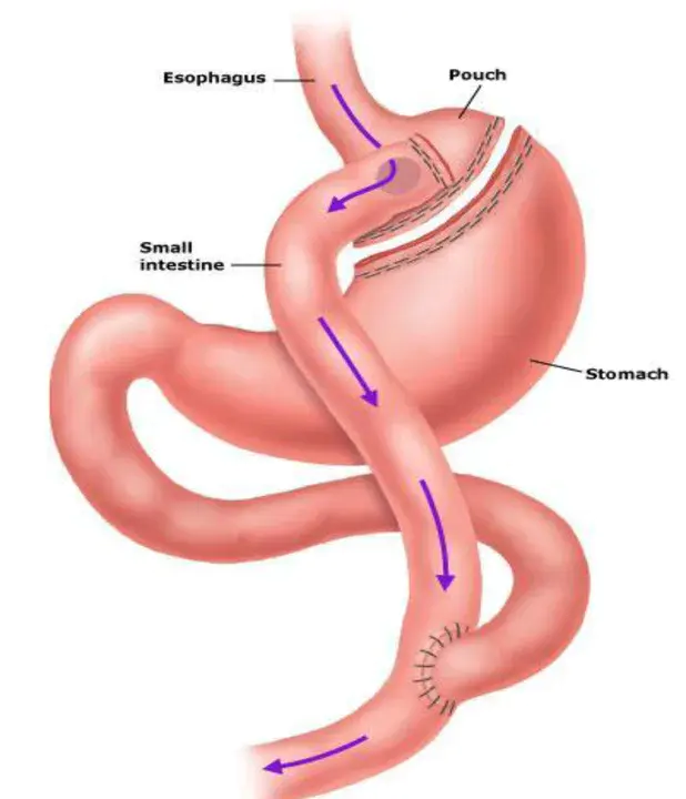 Gastric Outlet Obstruction : 胃出口梗阻