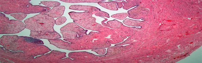 Solitary Eruptive Xanthogranuloma : 单发性喷发性黄原肉芽肿