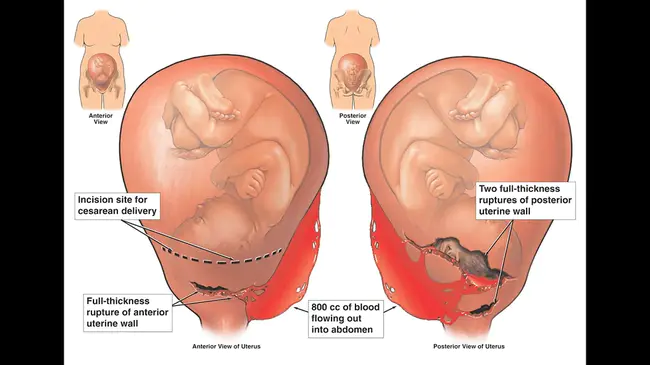 Uterine Artery Doppler : 子宫动脉多普勒