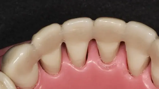 Splint Orthodontic Myofunctional Appliance : 夹板正畸肌功能矫治器