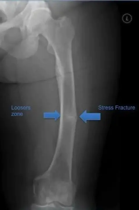 Hereditary hypophosphatemic rickets with hypercalciuria : 遗传性低磷血症性佝偻病伴高钙尿症