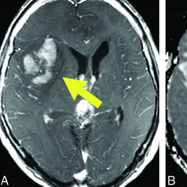 Brain Tumor Epidemiology Consortium : 脑肿瘤流行病学联合会