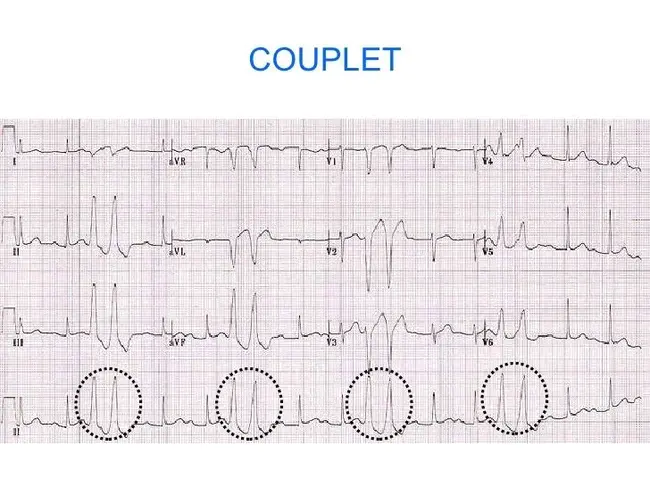 Ventricular Premature Beats : 室性早搏