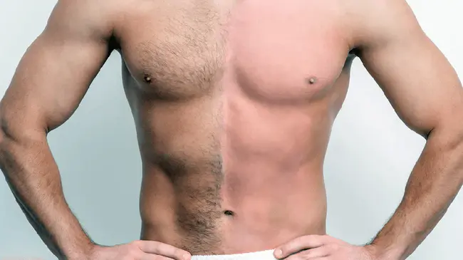 Body Hair Transplant : 体毛移植