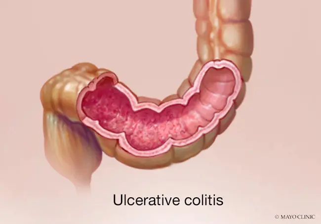 Ulcerative oral mucositis : 溃疡性口腔粘膜炎