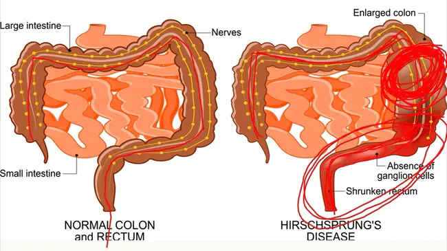 Hirschsprung disease : 先天性巨结肠病