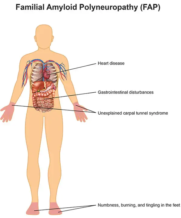 Familial Amyloidotic Polyneuropathy : 家族性淀粉样多神经病