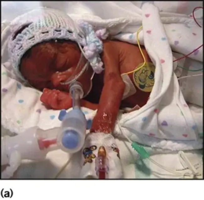 Maternal/Neonatal Tetanus : 产妇/新生儿破伤风