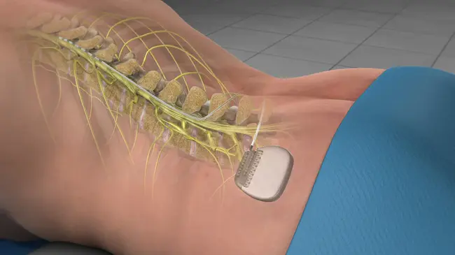 Spinal Cord Stimulator : 脊髓刺激器