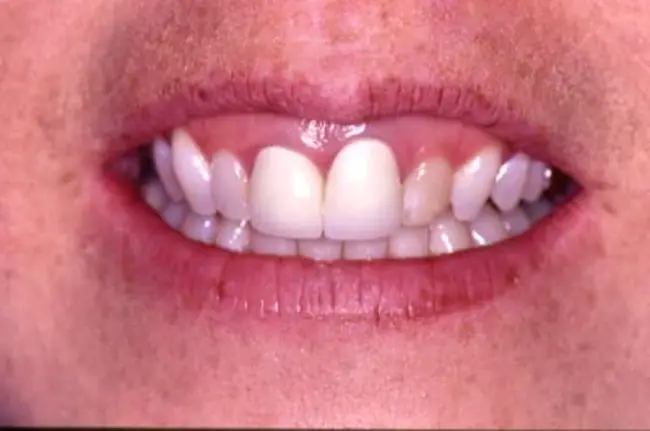 Tooth to Gum Ratio : 齿胶比