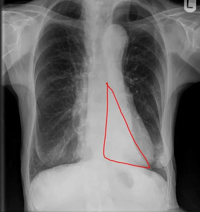 Lower Lobe : 下叶