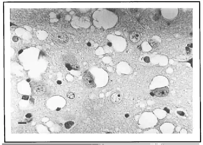 Creutzfeldt–Jakob disease : 克雅氏病