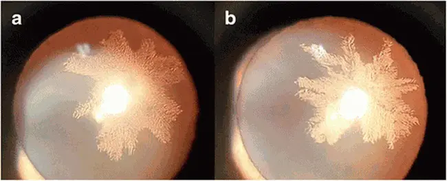 Posterior Subcasular Cataract : 后壁下白内障