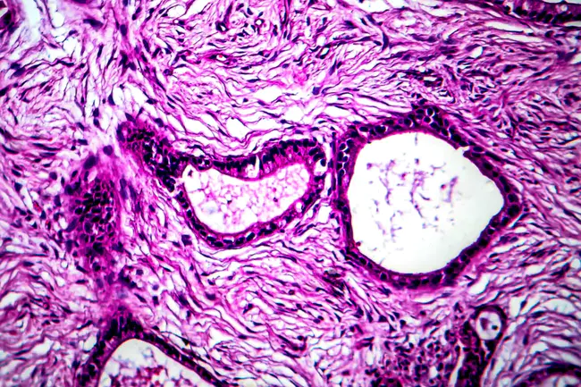 Uterine Corpus Endometrioid Carcinoma : 子宫体子宫内膜样癌