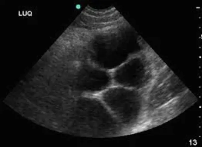 Polycystic Kidney : 多囊肾