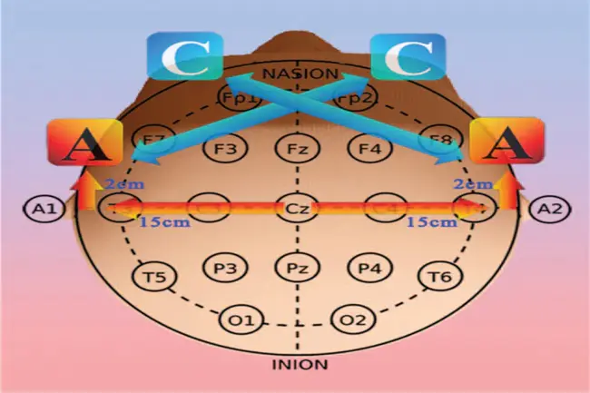 Transcranial Direct Current Stimulation : 经颅直流电刺激