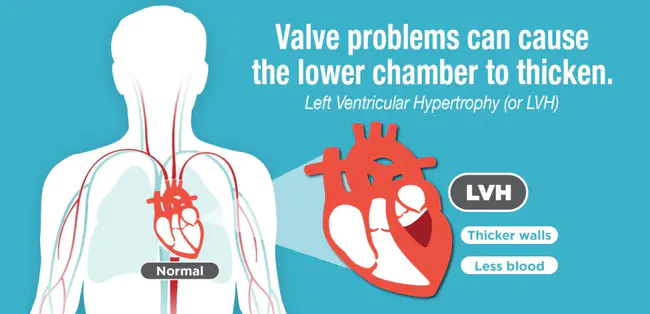 Left Ventricle Function : 左心室功能