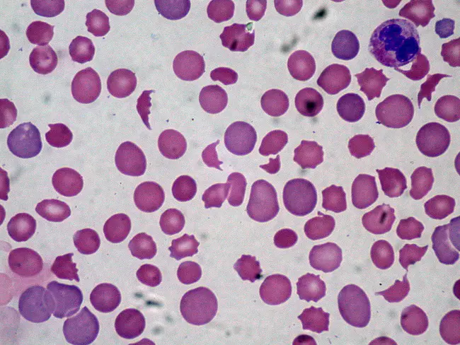 Haemolytic Uraemic Syndrome : 溶血尿毒综合征