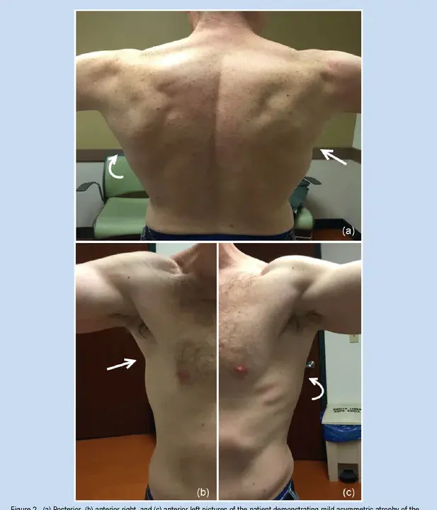 Latissimus Dorsi Myocutaneous Flap : 背阔肌肌皮瓣