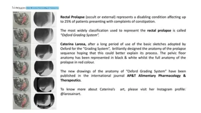 Low Grade Squamous Intraepithelial Lesion : 低度鳞状上皮内病变