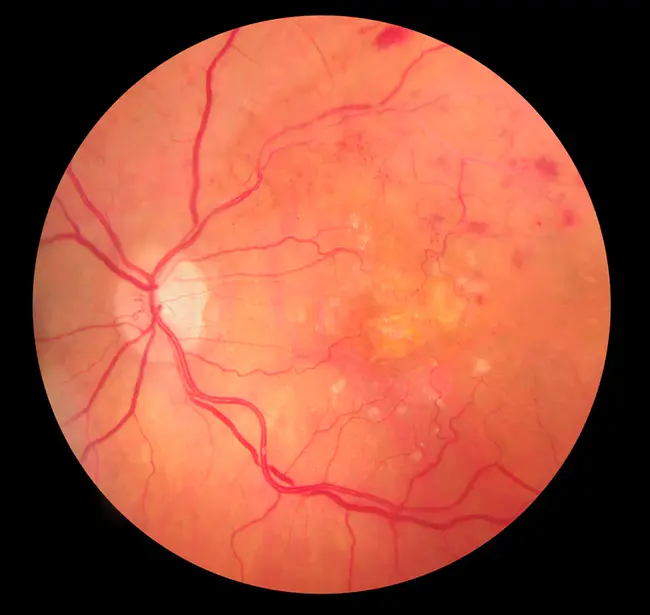 Retinal Vein Occlusion : 视网膜静脉阻塞