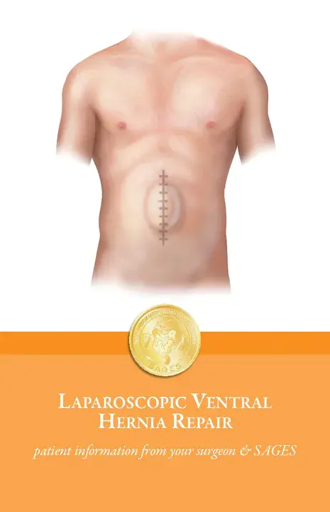 Ventral Incisional Hernia Repair : 腹壁切口疝修补术