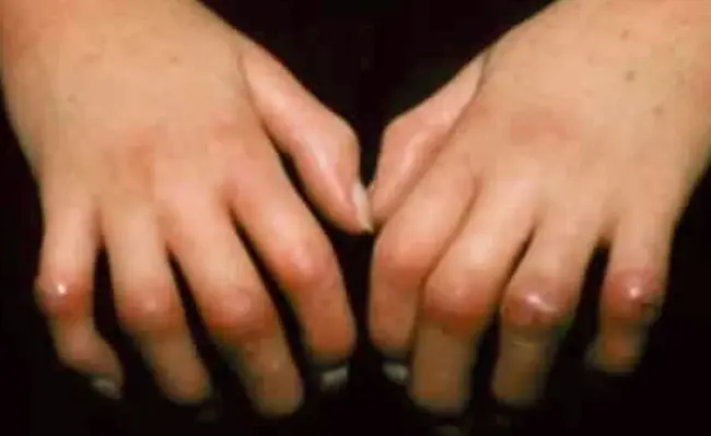 Scleroderma Cyclophosphamide Or Transplantation : 环磷酰胺硬皮病或移植