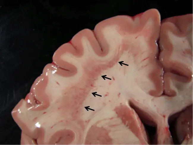 Subcortical ischemic vascular disease : 皮质下缺血性血管病