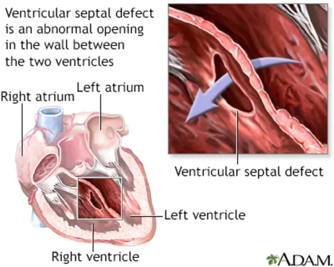 Endocardial cushion defect : 心内膜垫缺损