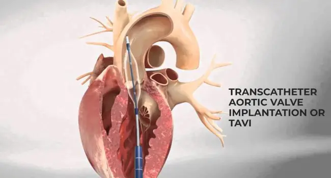 Transcatheter Aortic Valve Implant : 经导管主动脉瓣植入术