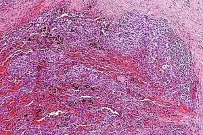 Angiomatoid Fibrous Histiocytoma : 血管瘤样纤维组织细胞瘤