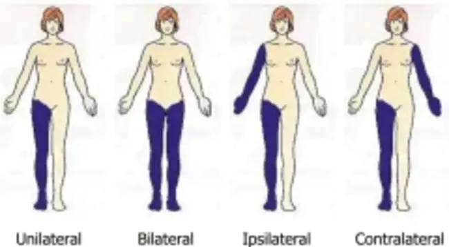 Ipsilateral Vascularised Fibular Transport : 同侧带血管腓骨运输