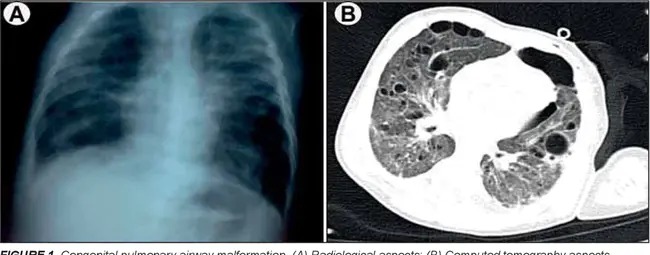Congenital pulmonary airway malformation : 先天性肺气道畸形