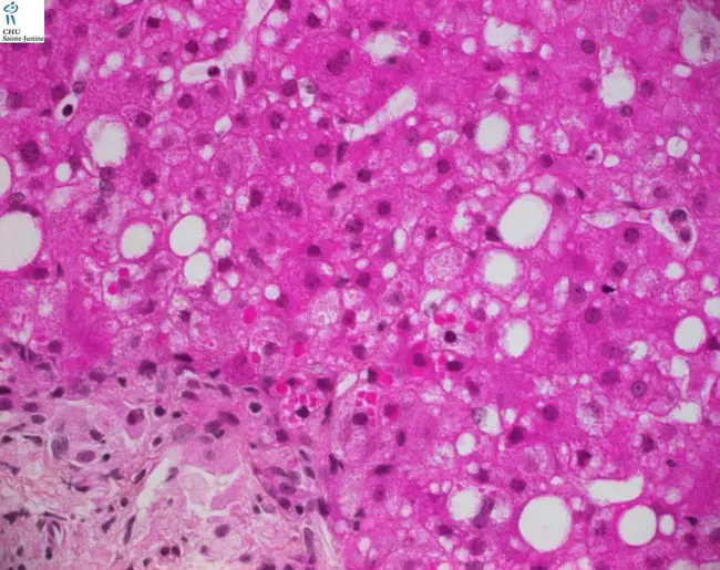 Lipid Laden Alveolar Macrophage : 含脂肺泡巨噬细胞