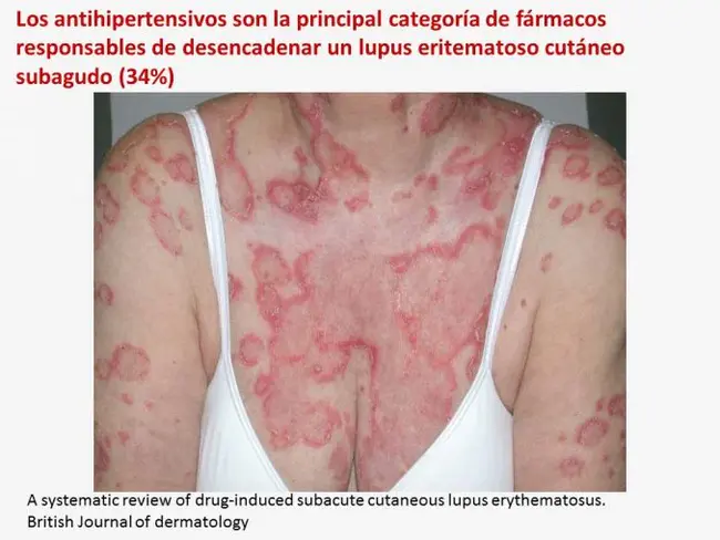 Chronic cutaneous lupus erythematosus : 慢性皮肤红斑狼疮