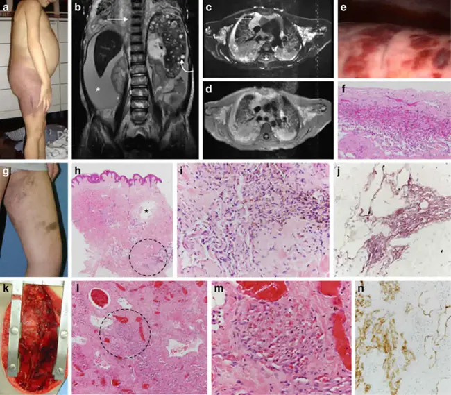 Lymphangioma like Kaposi sarcoma : 淋巴管瘤样卡波西肉瘤