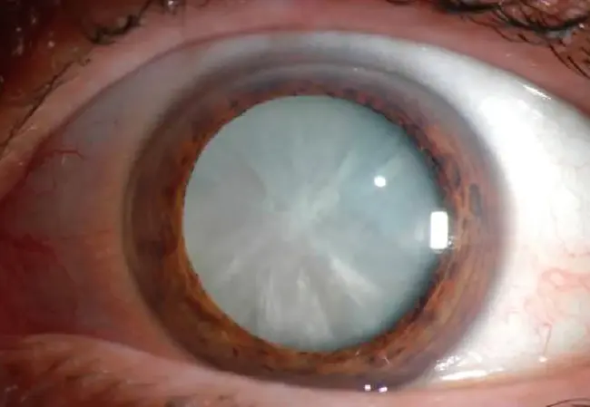 Cataract Zonular Pulverulent : 带状性白内障