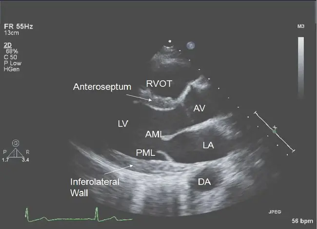 transthoracic echocardiogram : 经胸超声心动图