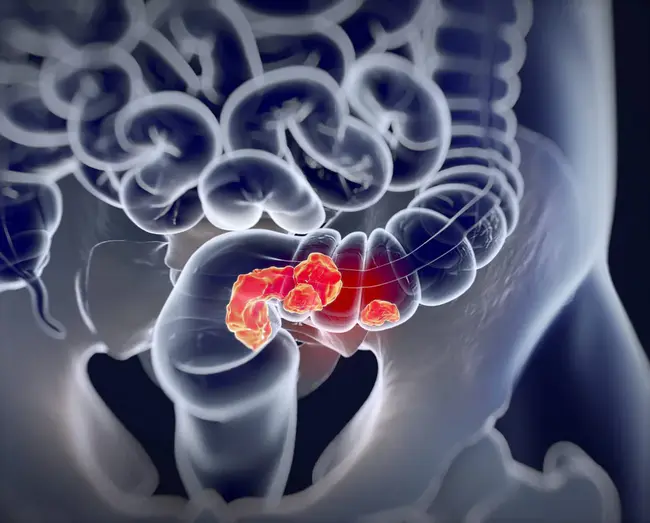 Transanal Endoscopic Microsurgery : 经肛门内镜显微手术