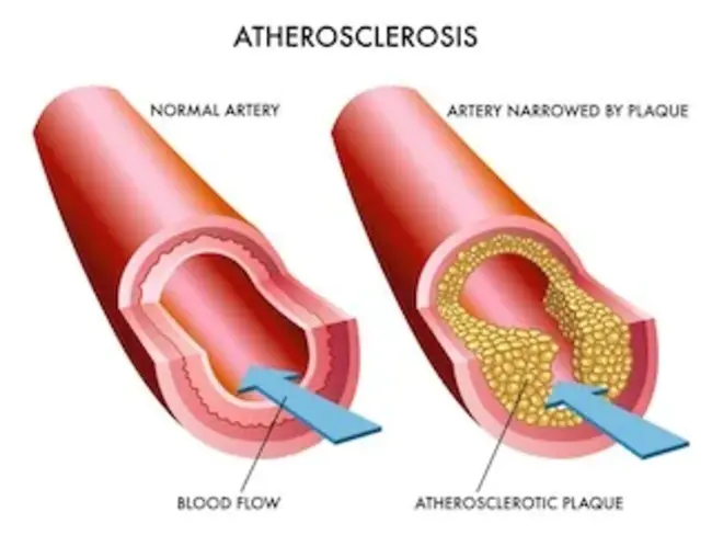 Atherosclerosis Risk in Communities Study : 社区动脉粥样硬化风险研究